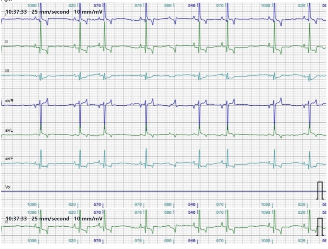 ECG